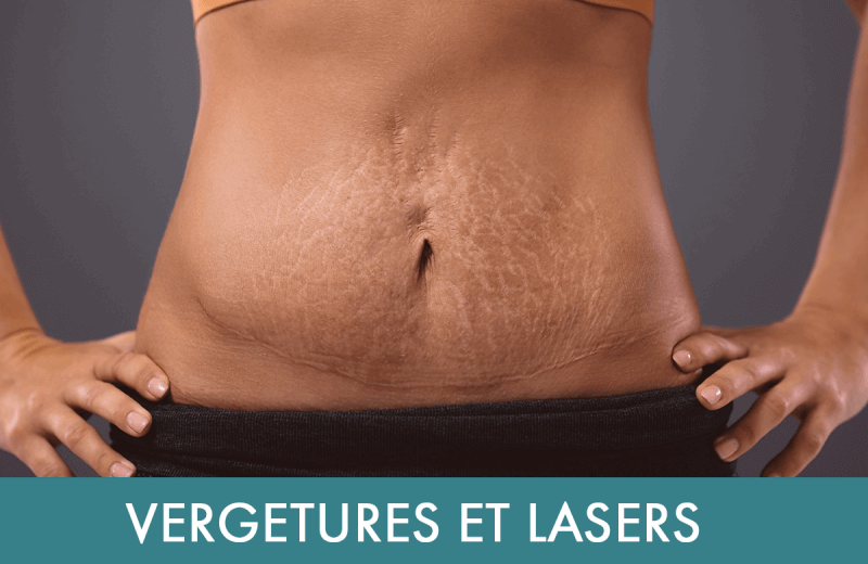 Traitement laser : Traitement des vergetures 