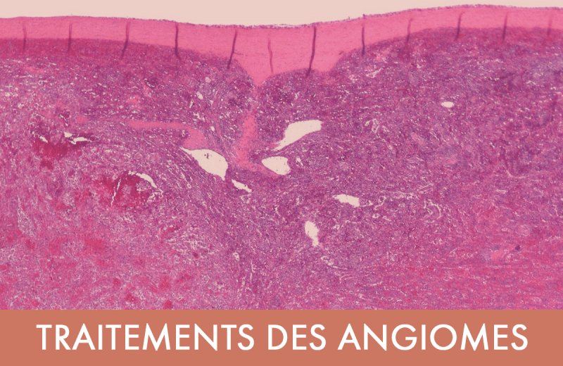 Traitement laser : Traitements des angiomes 