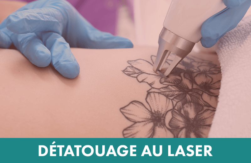Traitement laser : Détatouage au laser 