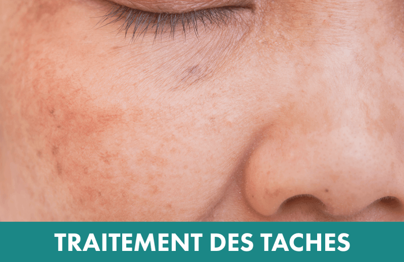 Les traitements laser 