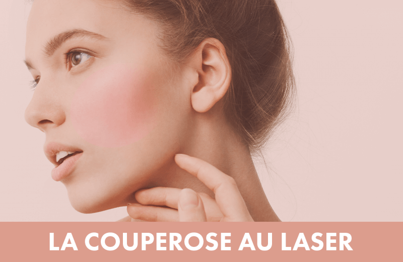 Traitement laser : Traitement de la couperose 