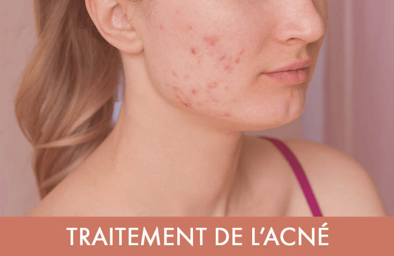Traitement laser : Traitement de l’acné au laser 