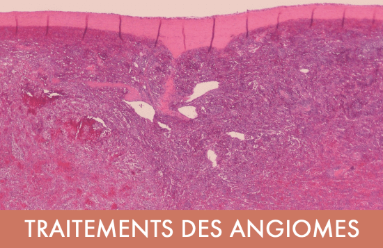 Traitement laser : Traitements des angiomes ("tache de naissance" ou "tache de vin"