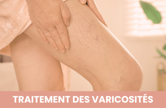 Traitement laser : Traitement des varicosités