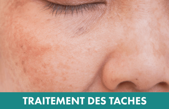 Traitement laser : Traitement des taches