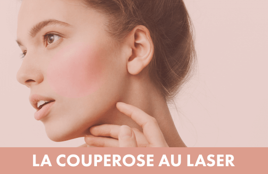 Traitement laser : Traitement de la couperose