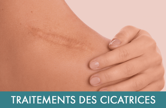 Traitement laser : Traitement des cicatrices