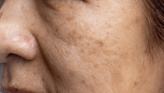 Pourquoi enlever vos taches brunes au laser en hiver ?