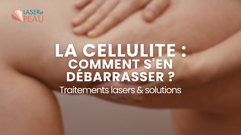 La cellulite : comment s'en débarrasser ? Traitements laser et solutions