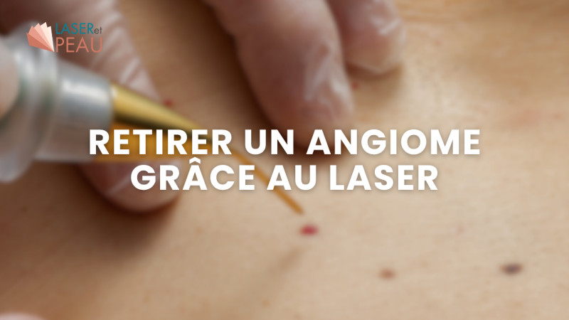 Comment enlever un angiome au laser ?